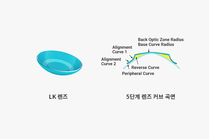 제게는 어떤 드림렌즈가 적합할까요?