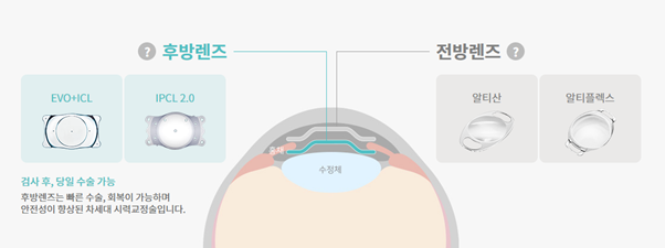 렌즈삽입술은 난시 교정도 가능한가요?2