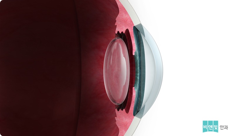 Eye anatomy. Cutaway illustration showing the internal structure and anatomy of a human eye. The front of the eye is at right. Light entering the eye passes through the pupil, a hole surrounded by the iris (coloured) that controls its size. The light then passes through the lens (centre) and is focused on the retina, a light-sensitive layer rich in blood vessels lining the rear and inside of the eye. The light triggers signals in the retina that are transmitted by the optic nerve to the brain. The optic nerve and blood vessels enter and leave through the back of the eye.