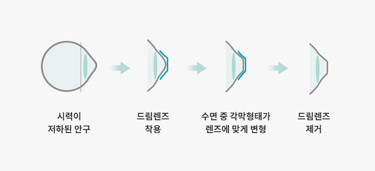 1.시력이 저하된 안구 2.드림렌즈 착용 3.수면 중 각막형태가 렌즈에 맞게 변형 4.드림렌즈 제거