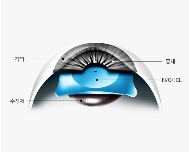 각막,홍채,EVO+ICL,수정채