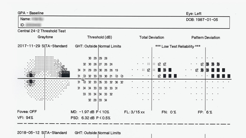 GPA (Glaucoma Progression Analysis)