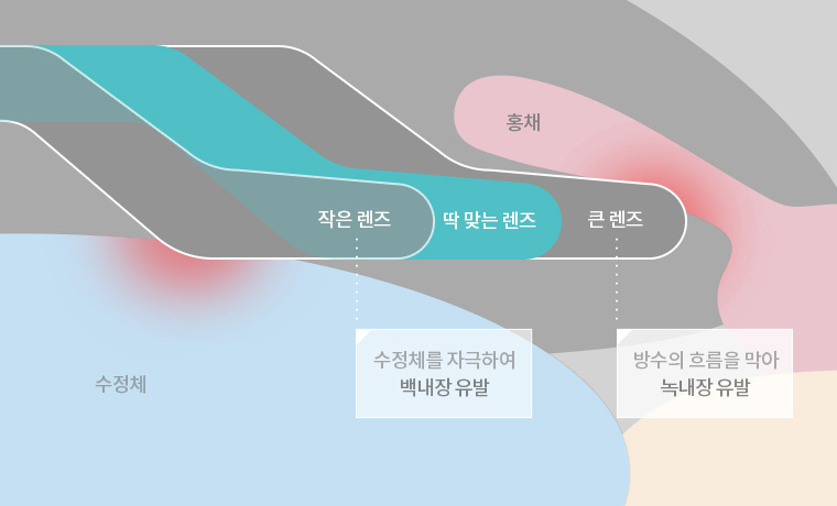 동양인 안구구조에 알맞는 고려아이텍KPL렌즈