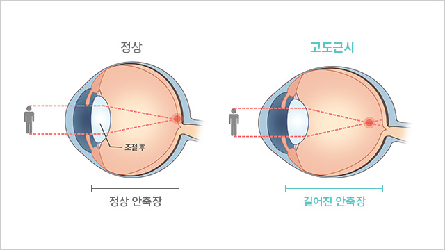 근시성 황반변성