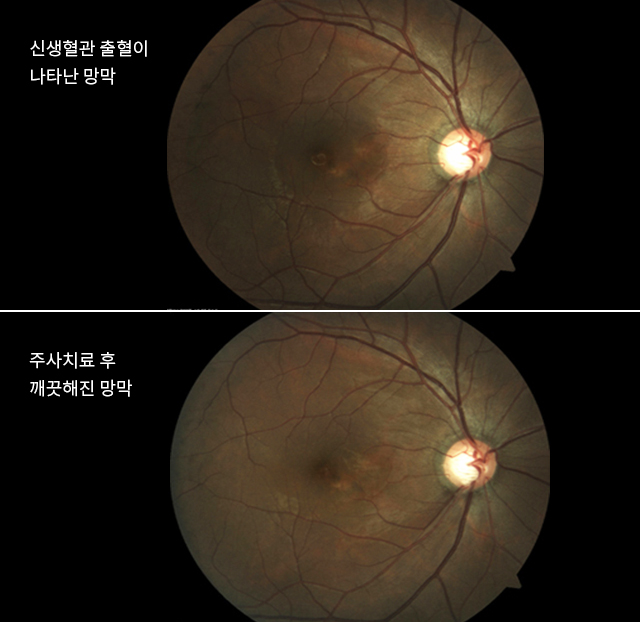 신생혈관 출혈이 나타난 망막, 주사치료 후 깨끗해진 망막