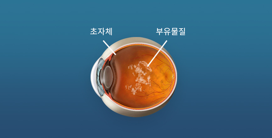 초자체 부유물질